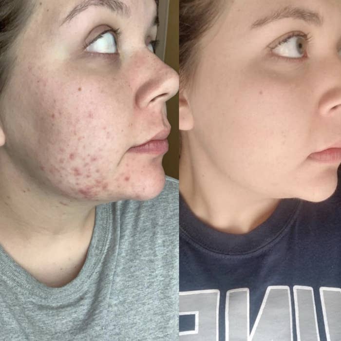 A woman with acne spots on her face and the same woman with an acne-free face