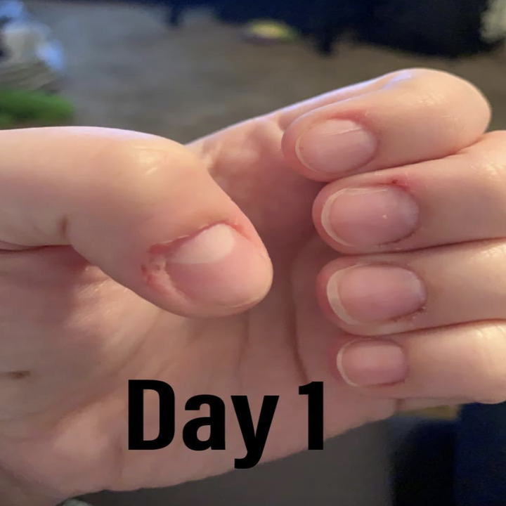fingernails and cuticles that have been picked at labeled "day 1" 