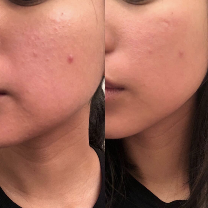 on the left a person with moderate acne across their left cheek and on the right the same person with significantly less acne