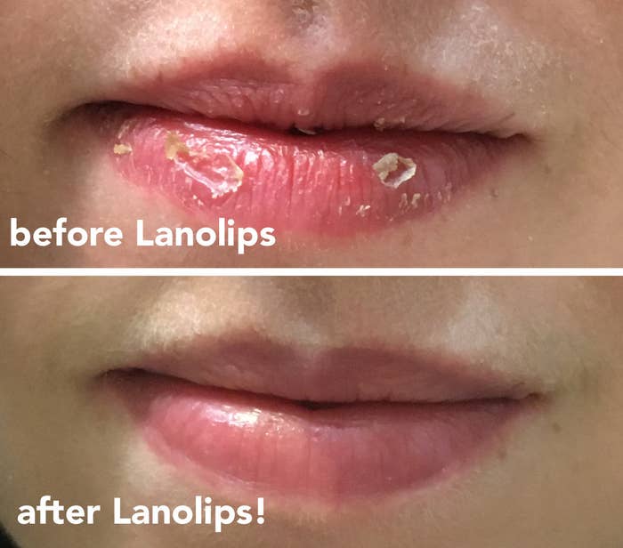 Two photos of BuzzFeed Shopping editor Natalie Brown&#x27;s lips: the top photo says &quot;before Lanolips&quot; and shows her lips with very chapped patches. The bottom says &quot;after Lanolips!&quot; and shows her lips shiny, smooth, and pink with all chapped parts gone