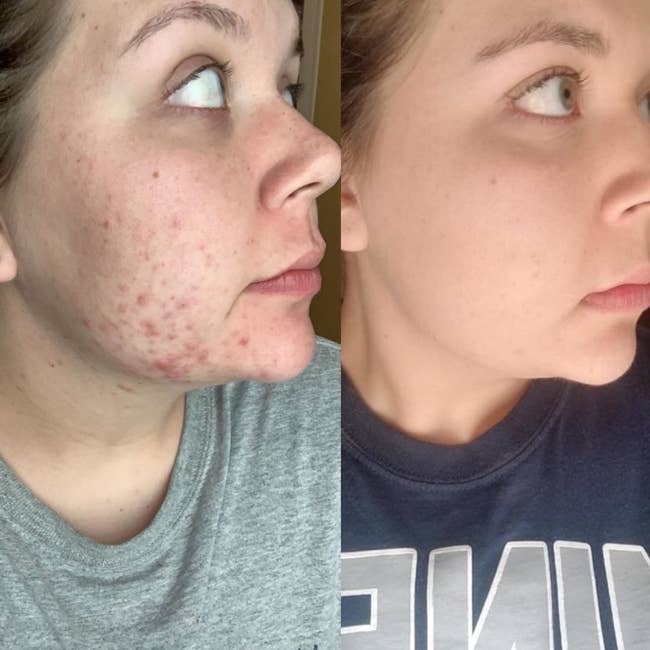 A before photo of a reviewer with lots of acne and acne scars around her chin and cheeks, and an after photo of the same reviewer with clear skin and basically no breakouts or scars