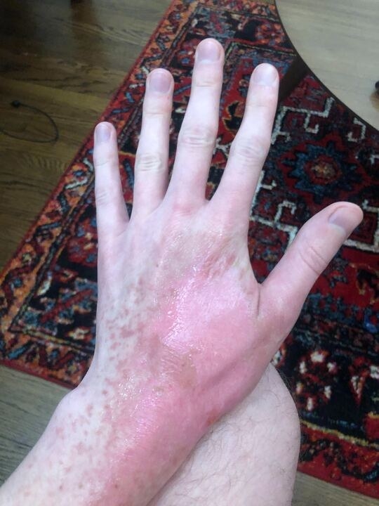 Lime Treatment For Burn