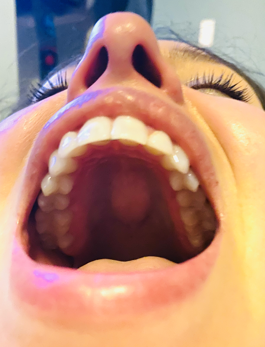 Hard Bump Roof Of Mouth