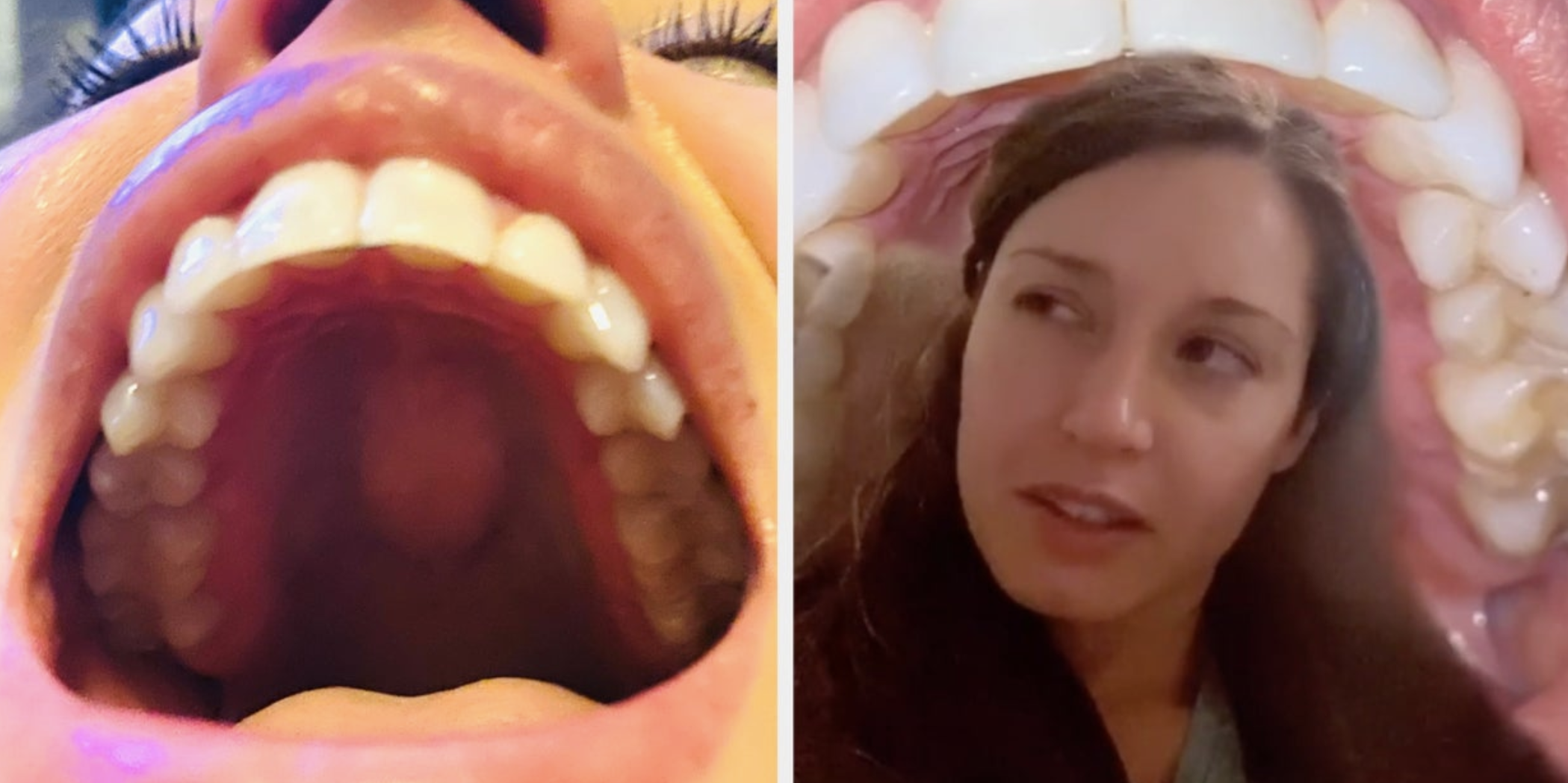 A Small Percentage Of People Have A Bump On The Roof Of Their Mouths