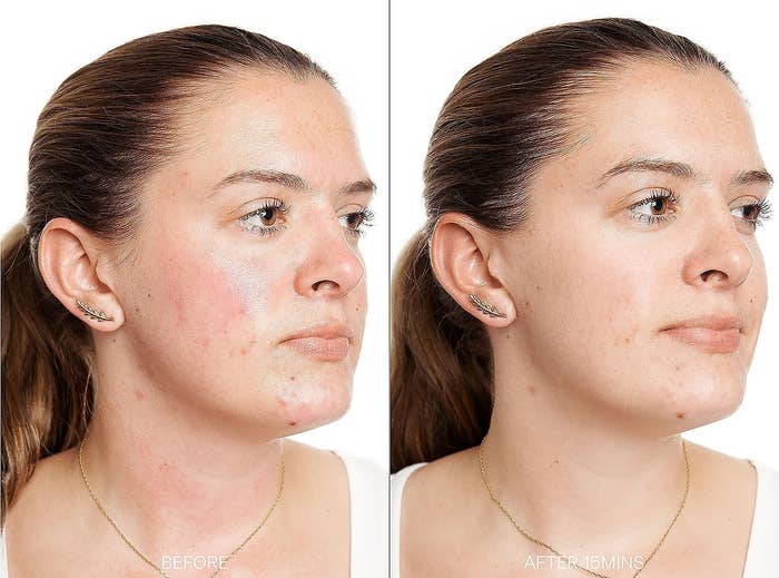 model with redness on necks and cheeks labeled &quot;before&quot; on the left, same model with no redness labeled &quot;after 15 mins&quot; on the right 