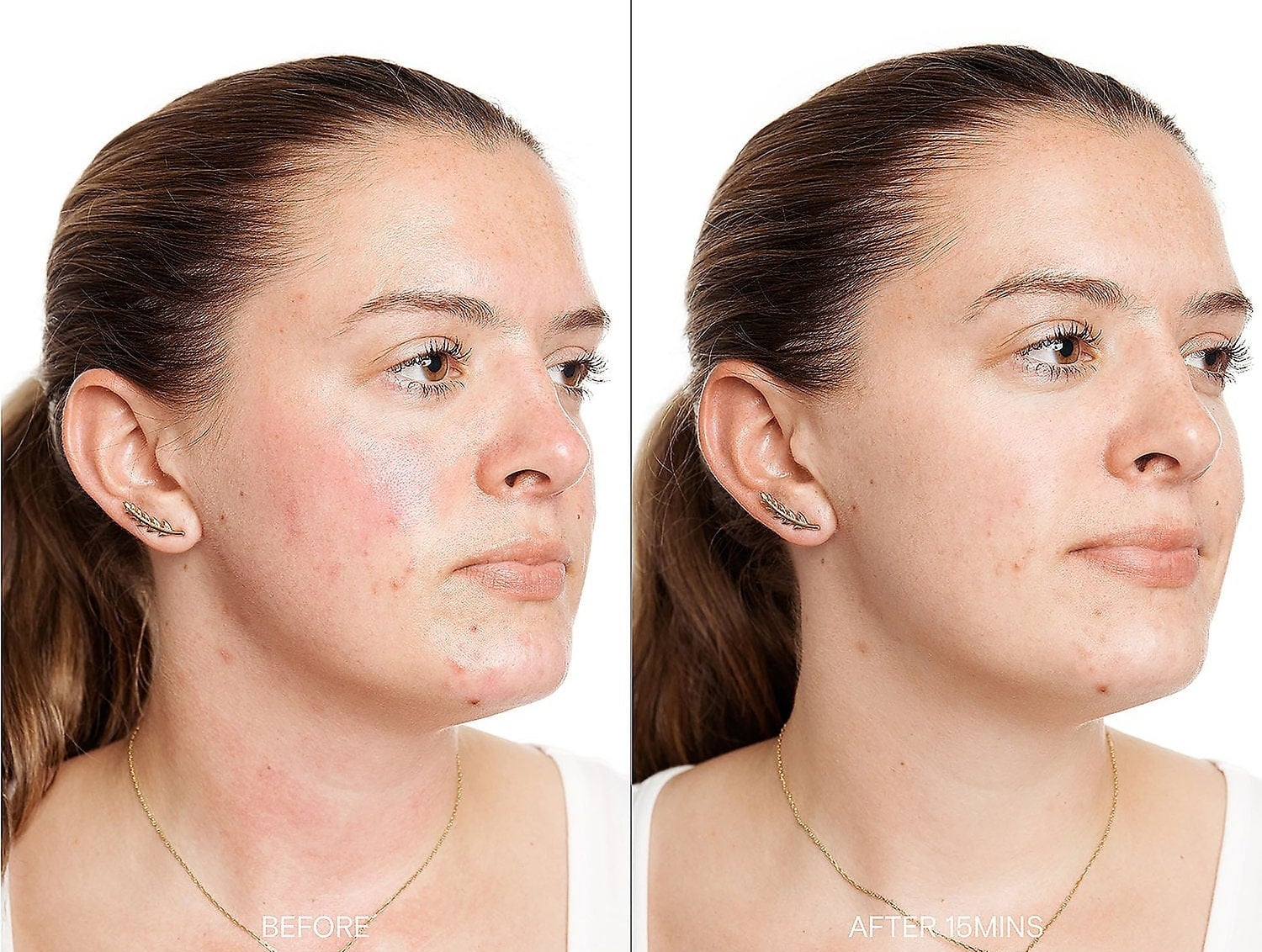 model with redness on necks and cheeks labeled "before" on the left, same model with no redness labeled "after 15 mins" on the right
