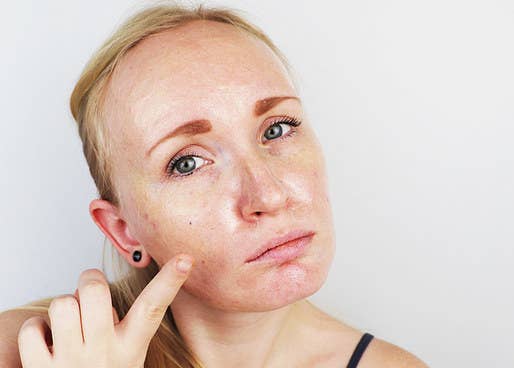 Would You Rather Acne Quiz