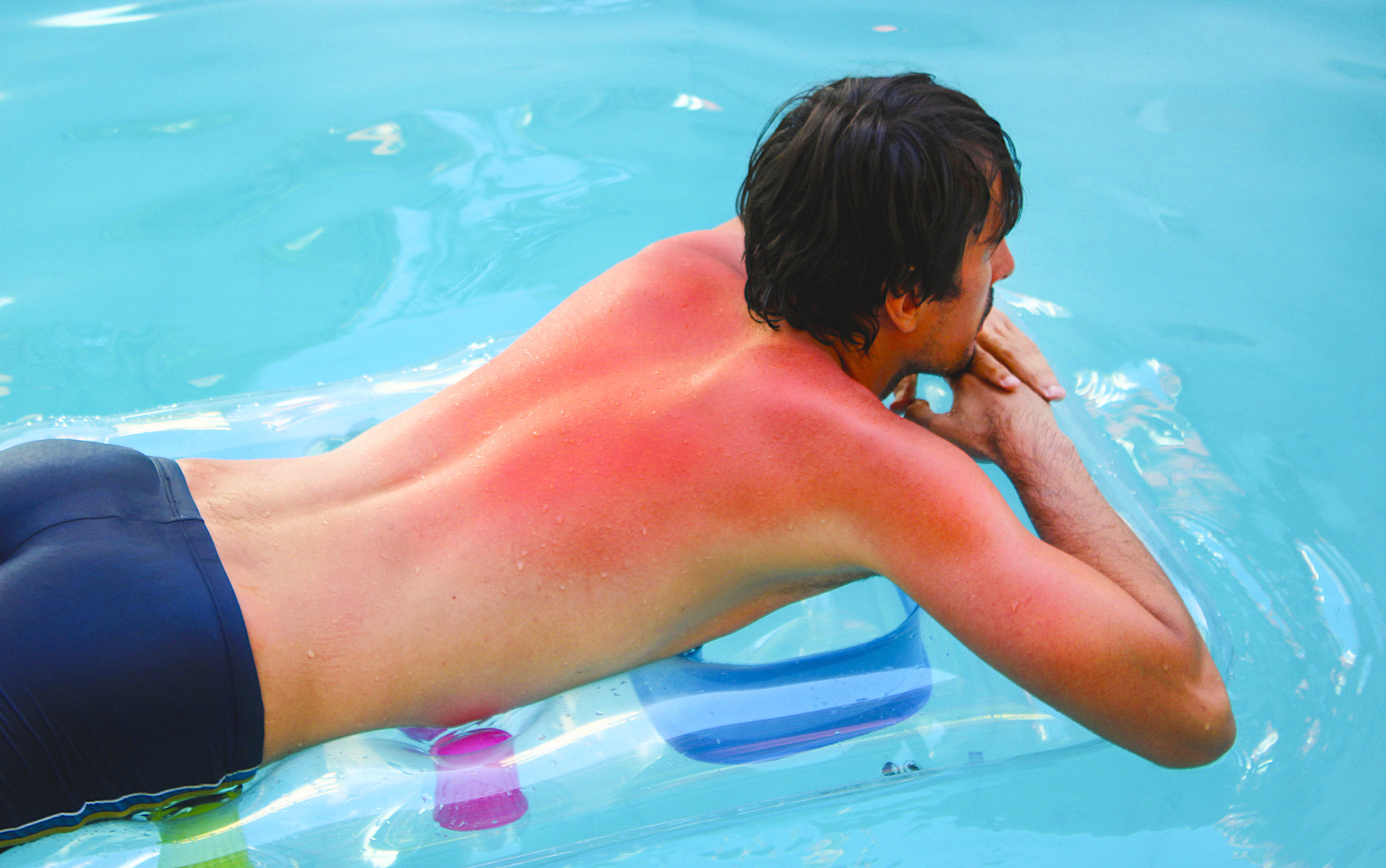 A man sunbathing on a lilo in a pool with sunburn.