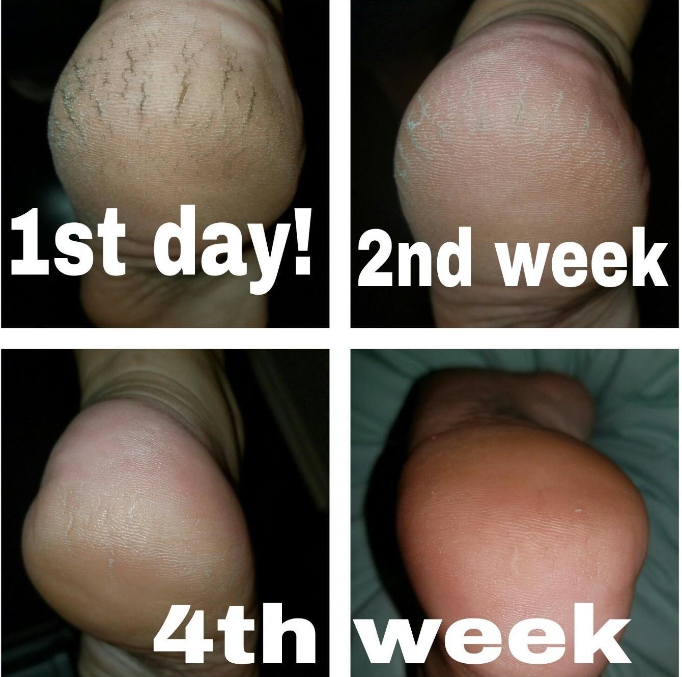 Four photos showing dry, discolored heels on the first day of use versus smoother looking heels with no visible cracks by the fourth week of use