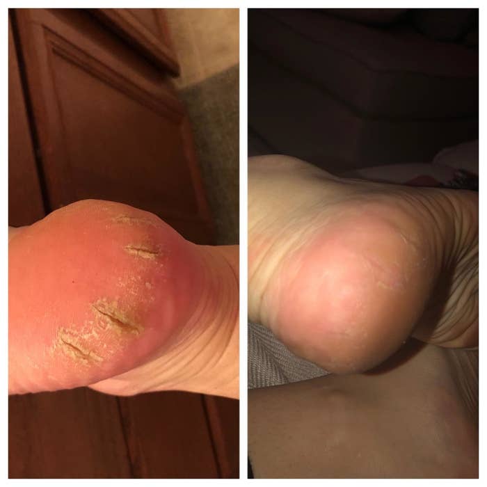 How do I get rid of these foot calluses? I hate how they've turned my foot  yellow :( : r/beauty