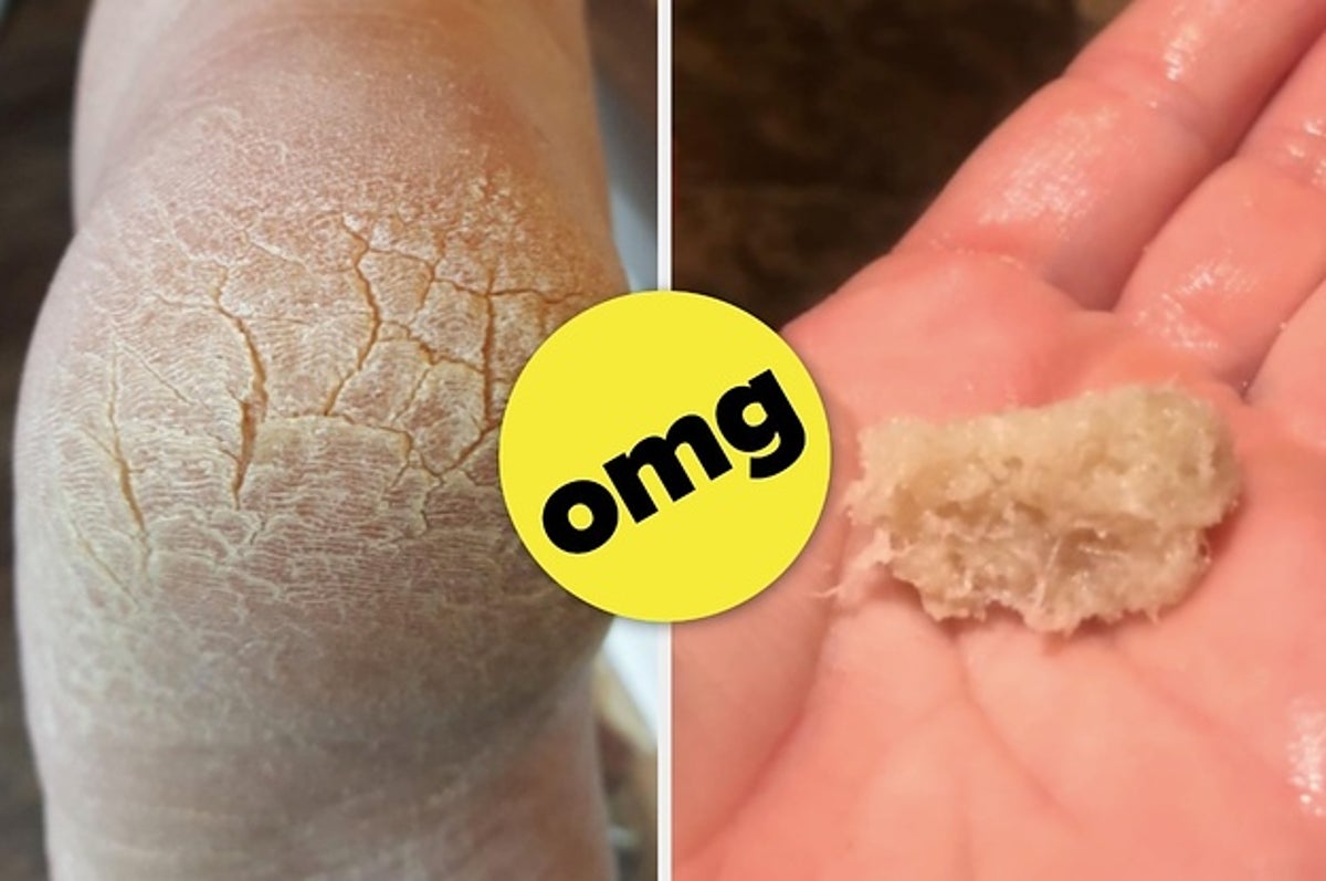 Foot Products With Before And After Photos You'll Either Love Or Hate
