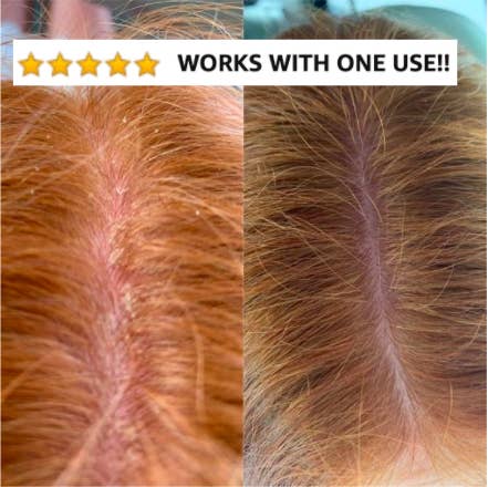 reviewer before and after photo of dandruff on the left and none on the right 
