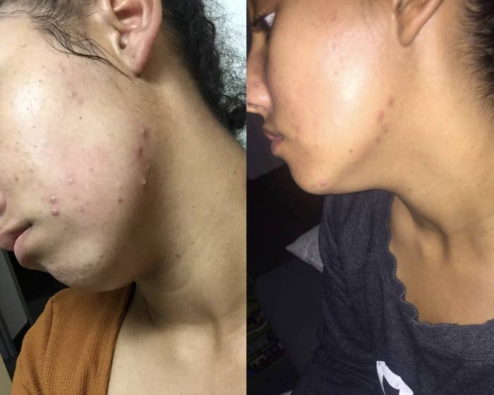 on the left a person with moderate acne across their chin and jaw and on the right the same person with significantly less acne 