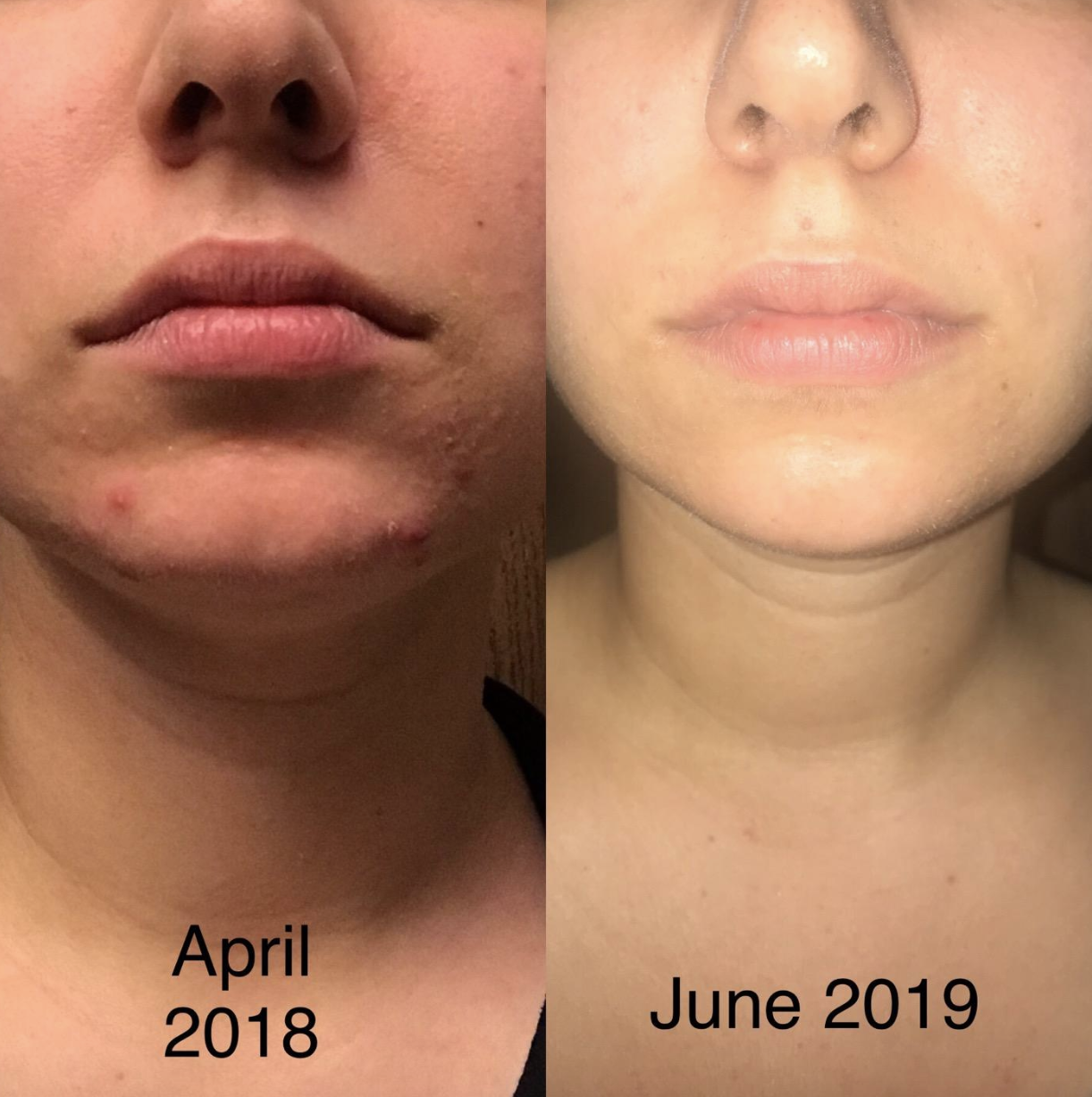 on the left a person with moderate acne across their chin labeled &quot;April 2018&quot; and on the right the same person with significantly less acne labeled &quot;June 2019&quot; 