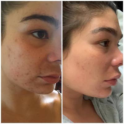 A before-and-after of a person with a lot of acne scars on their face compared to a much clearer complexion with only 3-4 scars still visible 