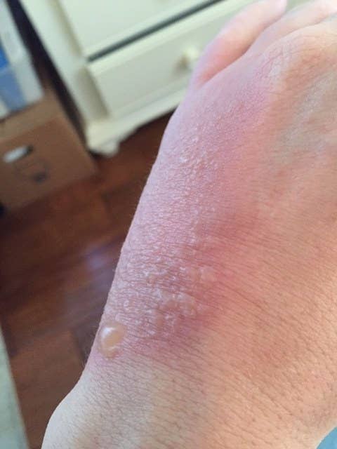 Phytophotodermatitis: Everything You Need To Know About The Lime And ...
