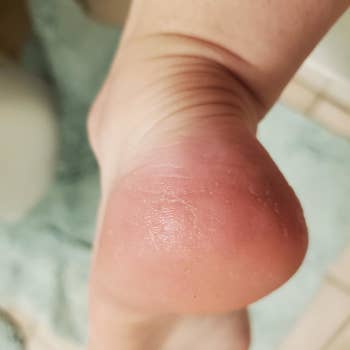 The same reviewer's heel looking smooth and callous-free after using the file 