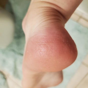 The same reviewer's heel looking smooth and callous-free after using the file 