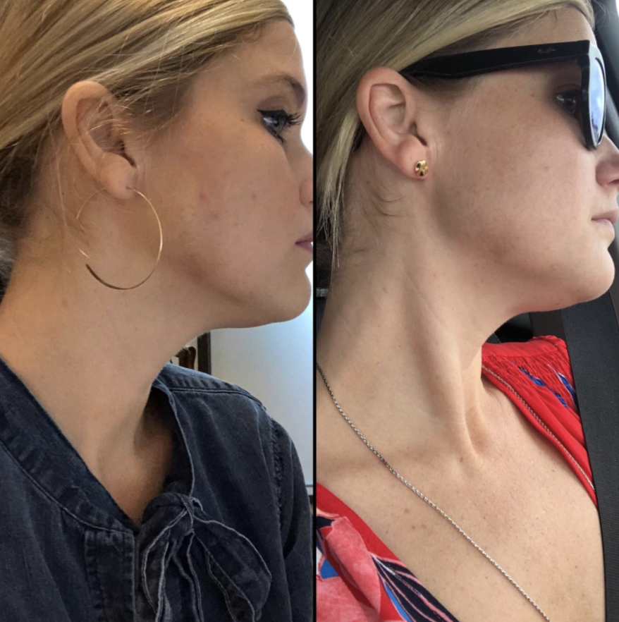On the left, reviewer's face with acne melasma. On the right, reviewer's face with clearer skin after using TruSkin Naturals' Hyaluronic Acid Serum