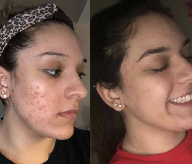 On the left, reviewer's face covered in acne spots. On the right, the reviewer's face with less acne spots after using CeraVe's Hydrating Face Wash