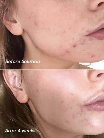 On the left, a model's face with breakouts before using the solution. On the right, a model's face with less breakouts after using the solution for four weeks