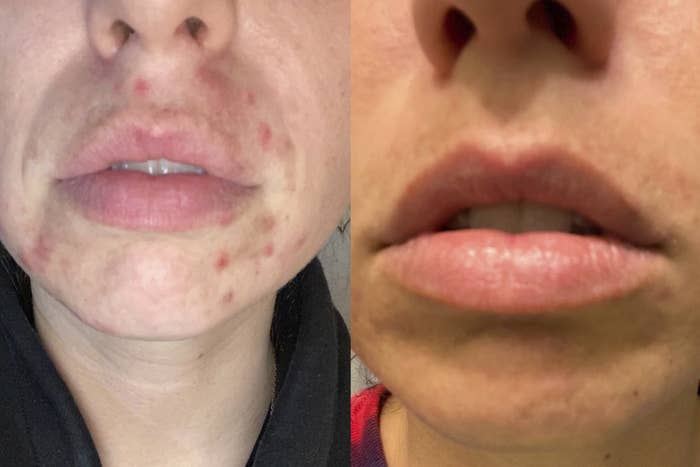 Left side: Reviewer has large red acne spots underneath their nose, around their lips, and on the chin. Right side shows same reviewer with zero acne spots or redness in those areas.