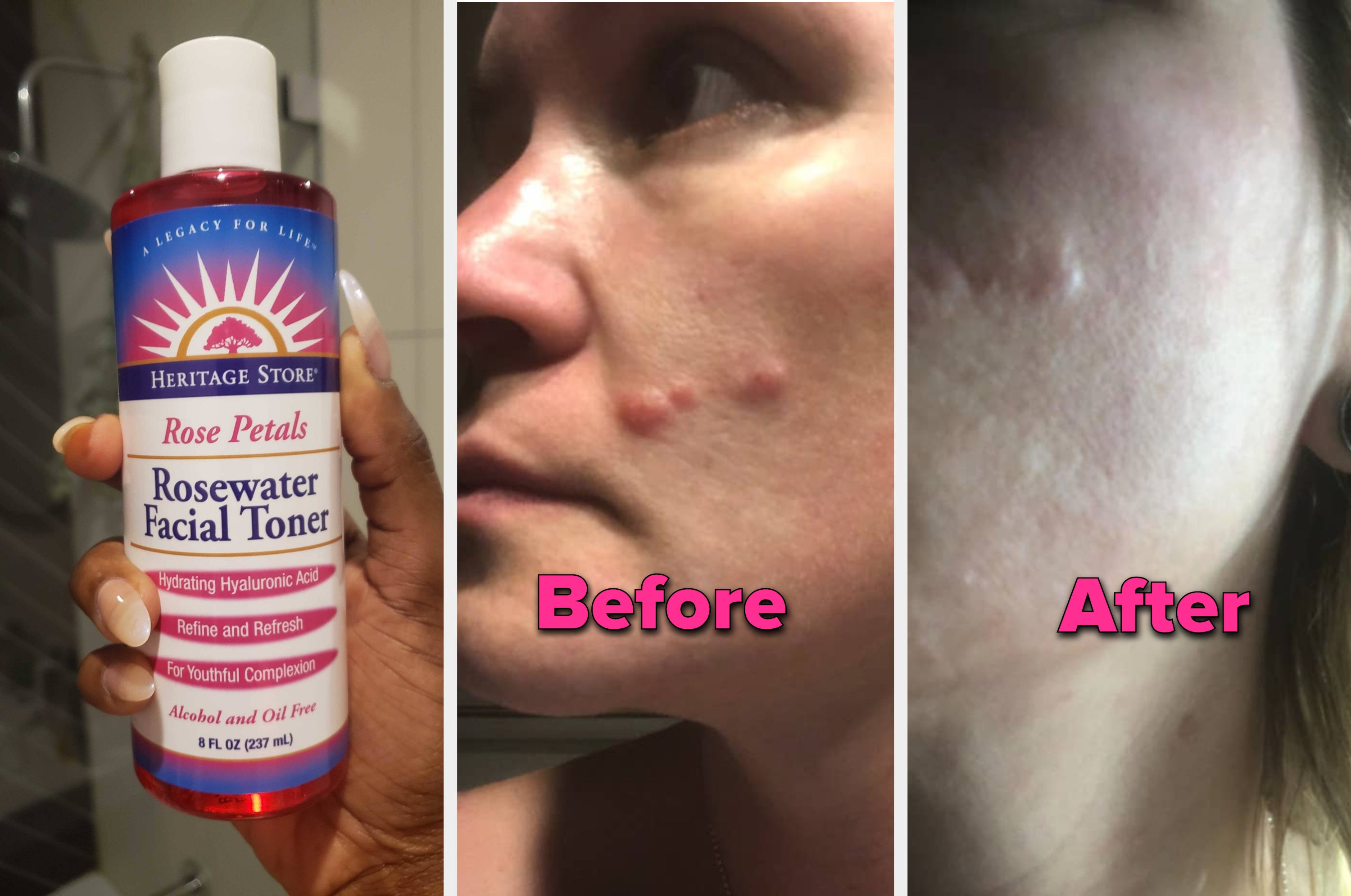 best products for stress acne