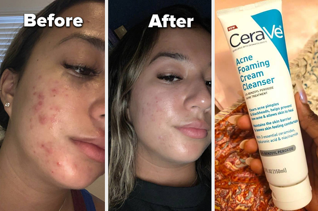 18 Products That May Help If You've Got Stress Acne Right Now