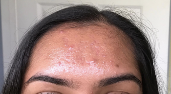 A reviewer image of a person's forehead shiny with oil 