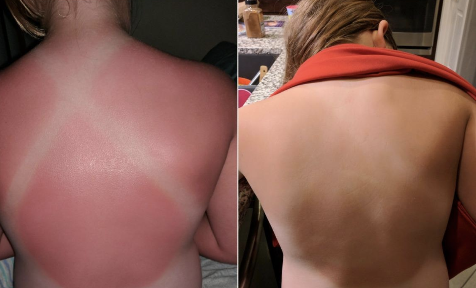 A reviewer image of a burnt back and an &quot;after&quot; image of their back without any redness 