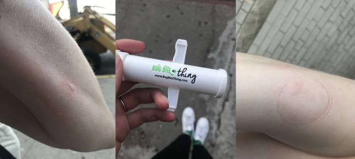 A BuzzFeed editor&#x27;s arm with a bite on it &quot;before,&quot; a pic of the bug bite tool, and a pic of the editor&#x27;s arm after it&#x27;s been suctioned with swelling/redness reduced 