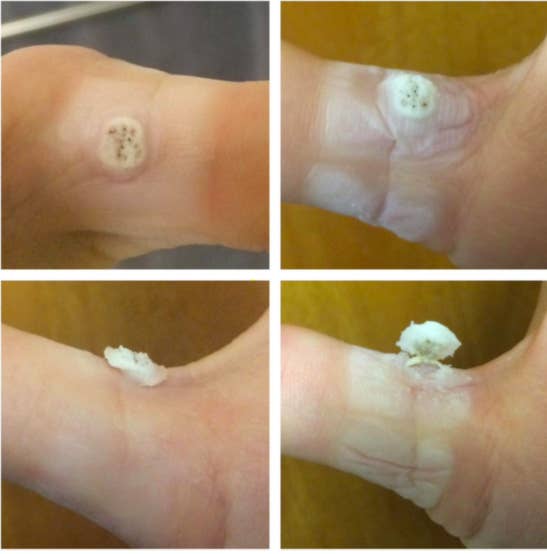 A set of four reviewer pictures: The wart turned white, the ward even whiter and starting to rise, the ward starting to separate, and the wart peeling off