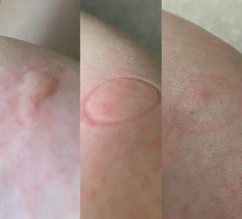 A before, during, and after photo of a bug bite going down since using the suction tool