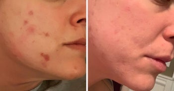 On the left, a before photo of a person with acne on their face, and on the right, the same person, but their acne clearing up