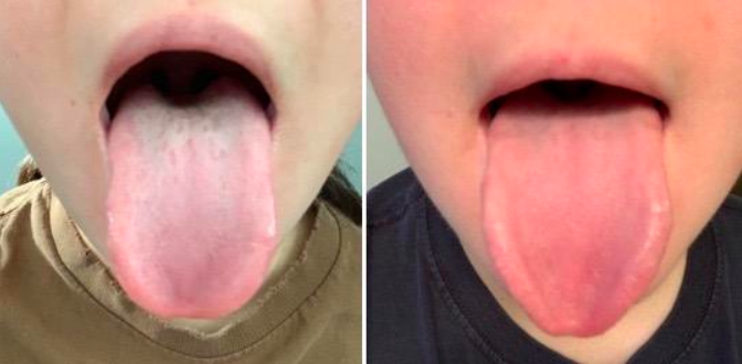 On the left, a reviewer's tongue with grayish-white residue coating the back. On the right, the same reviewer's tongue looking pink and clean