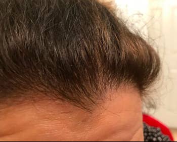 The same reviewer's hairline looking smooth, with all the flakes gone