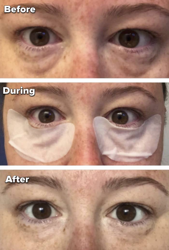 The top photo shows a reviewer with bags underneath their eyes. Middle photo is of the same person wearing the eye patches. Last photo shows the person with a decrease in bags.