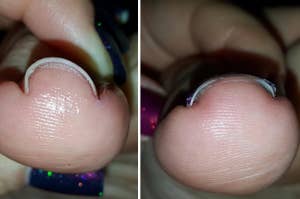 on the left a big toenail curved inward into the toe, on the right the same nail straightened out to a normal gentle curve 