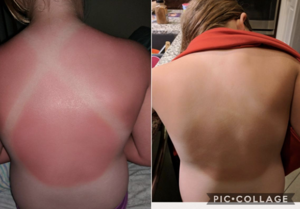 Reviewer before-and-after photos showing badly burnt skin, followed by skin that&#x27;s much less red with no peeling