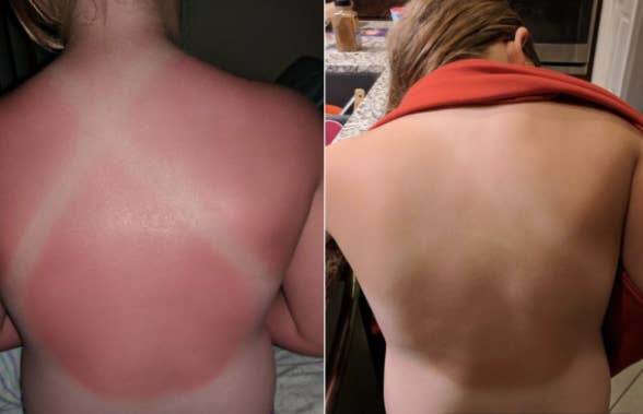 to the left: a badly burnt back of a reviewer, to the right: the same back healed and tan
