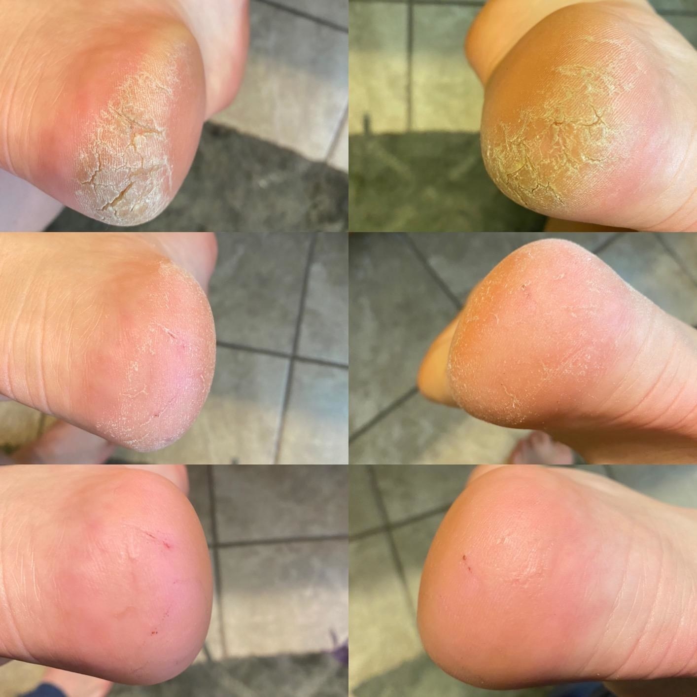 A collage of six images: the top cracked heels before treatment, the middle mid-treatment, the bottom after lotioning, not cracked  at all