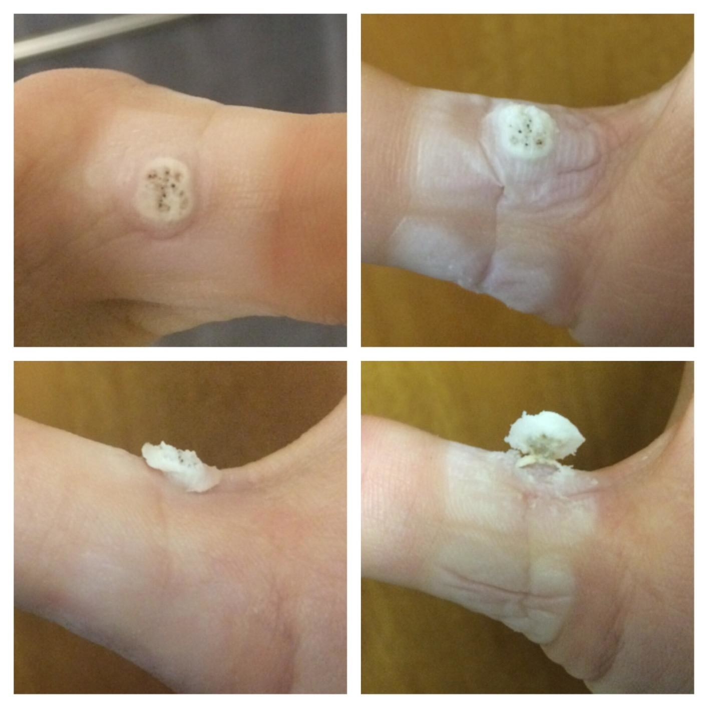 four images of a reviewer&#x27;s wart breaking through the skin and erupting outward