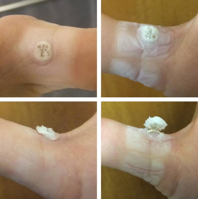 four images of a reviewer's wart breaking through the skin and erupting outward