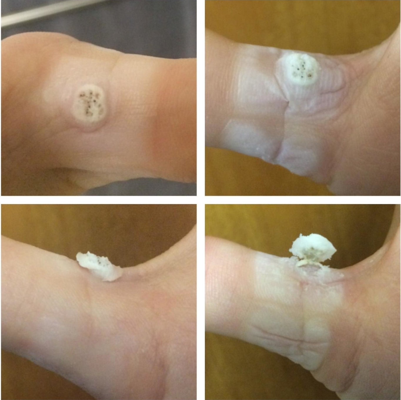 four images of a reviewer's wart breaking through the skin and erupting outward