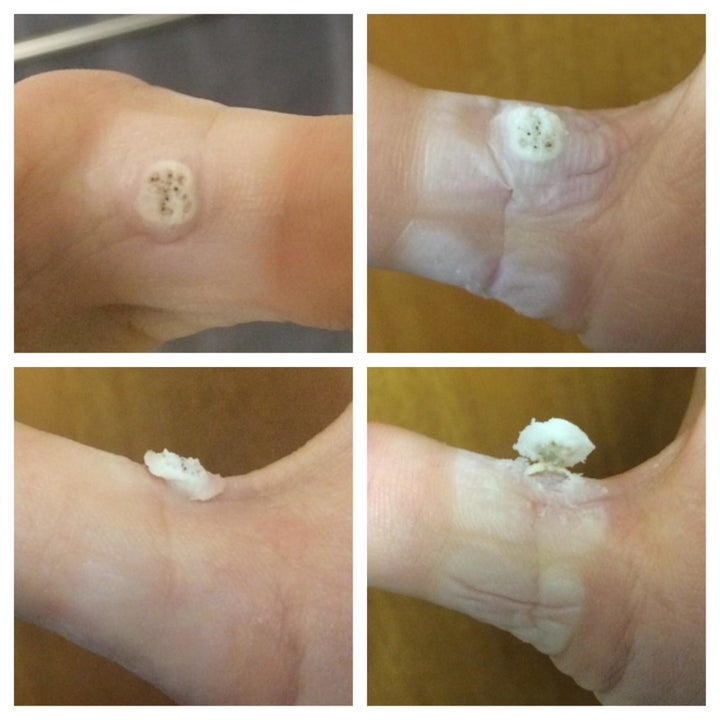 four images of a reviewer's wart breaking through the skin and erupting outward