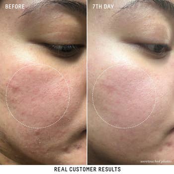 Customer review photo provided by Biossance showing face before and after using the serum over the span of seven days. The before photo shows redness and uneven texture and the after photo shows smoother texture and less redness