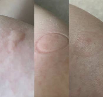 a before and after reviewer photo of a swollen bite, a suction mark imprint, and reduced swelling 