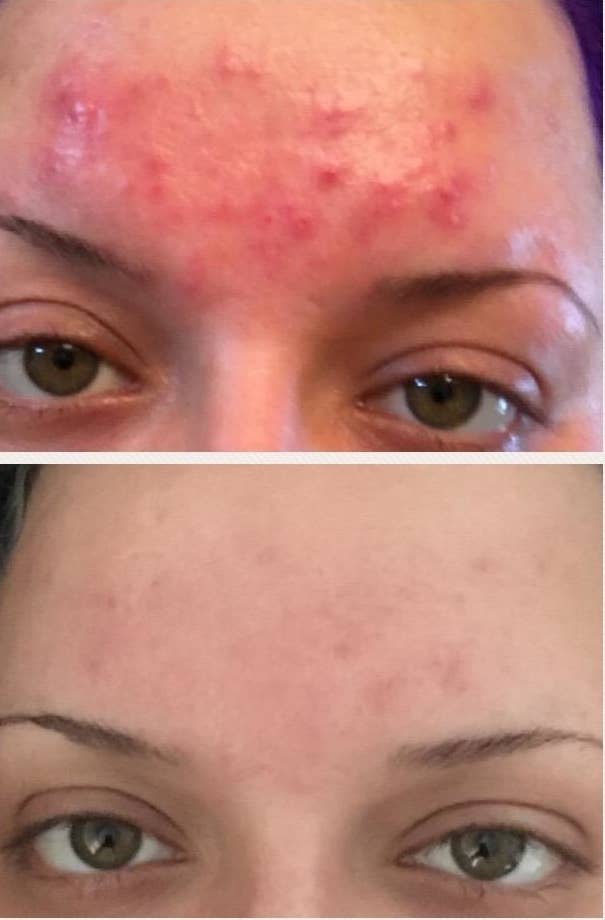 Reviewer&#x27;s before and after showing that the cleanser cleared up all of their angry forehead breakouts with minimal scarring