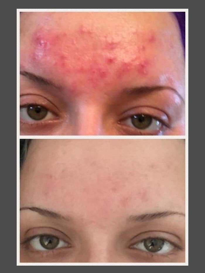 Reviewer's before and after showing that the cleanser cleared up all of their angry forehead breakouts with minimal scarring