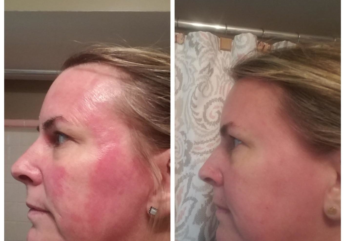 Reviewer before and after photo showing the cream substantially reduced redness on their cheek